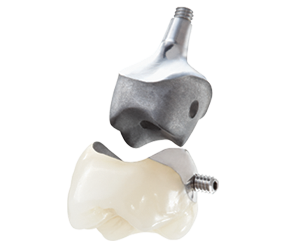 Custom Abutment With Lingual Screw Retained crown